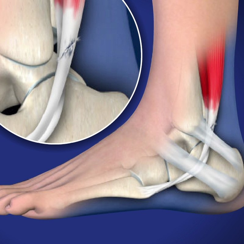 Neoprene Ayak Bileği Bağı M Beden 1